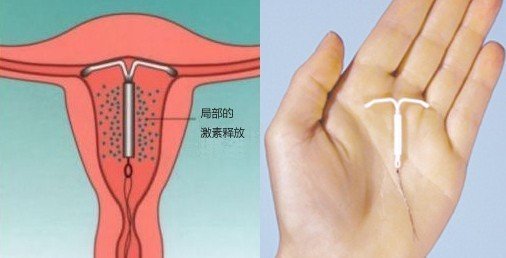 避孕最新方法,避孕最新方法，探索现代避孕技术的革新与选择